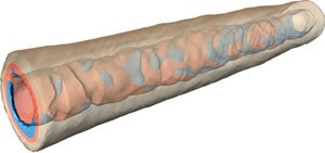 Visualization of a patient-specific arterial geometry Visualization of a patient-specific arterial geometry